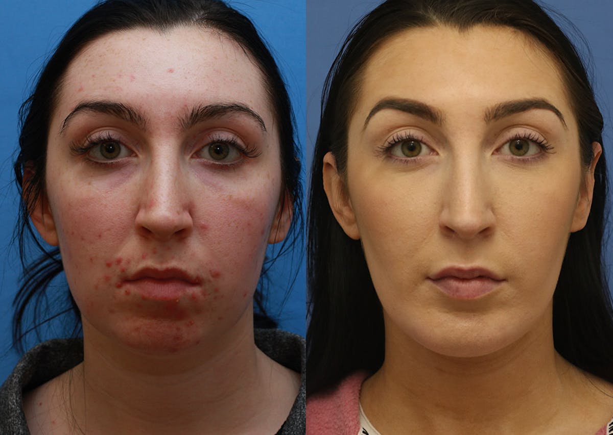 Chin Implants Before & After Gallery - Patient 343129 - Image 3