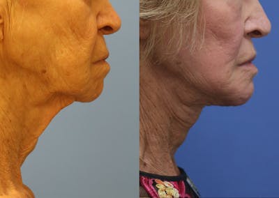 Chin Implants Before & After Gallery - Patient 287213 - Image 1