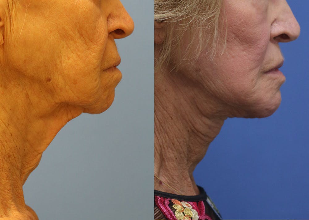 Chin Implants Before & After Gallery - Patient 287213 - Image 1