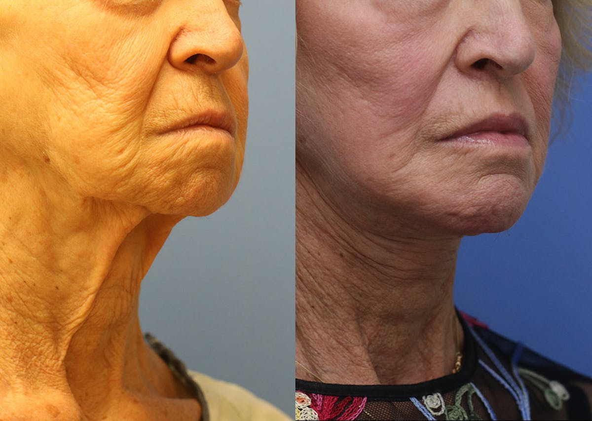 Chin Implants Before & After Gallery - Patient 287213 - Image 2