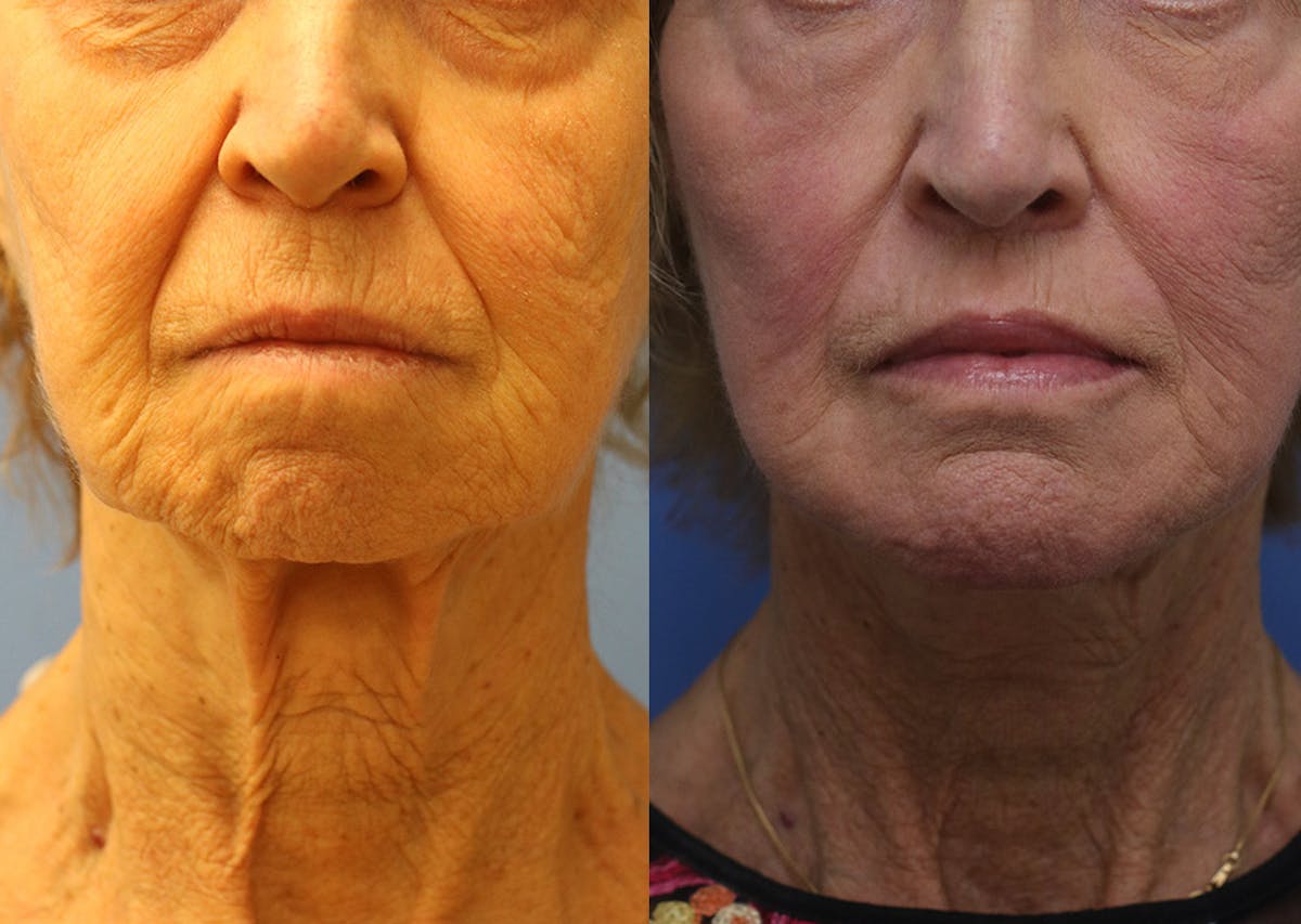 Chin Implants Before & After Gallery - Patient 287213 - Image 3