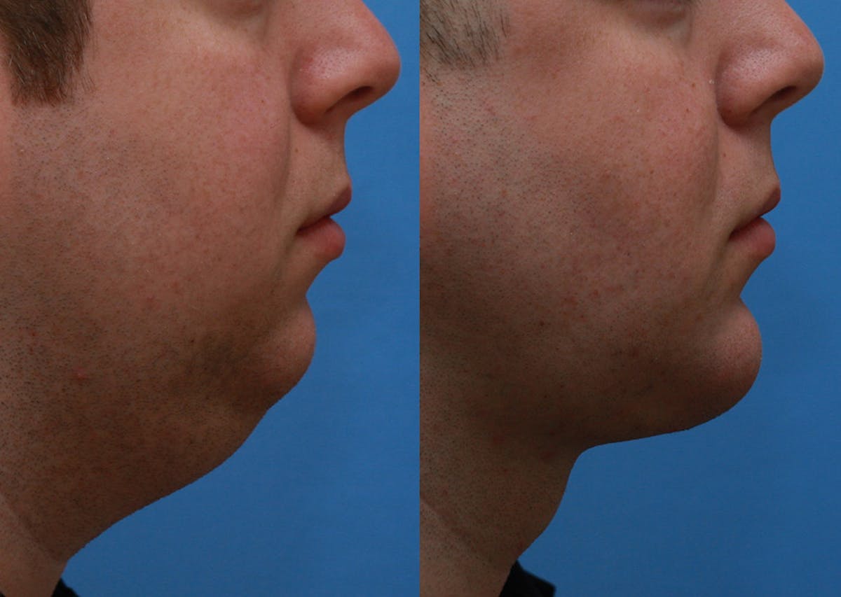Chin Implants Before & After Gallery - Patient 175971 - Image 1