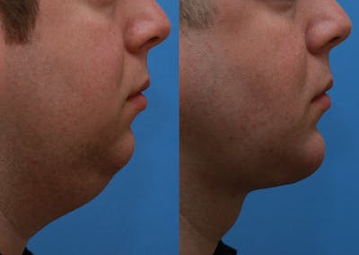 Chin Implants Before & After Gallery - Patient 175971 - Image 1