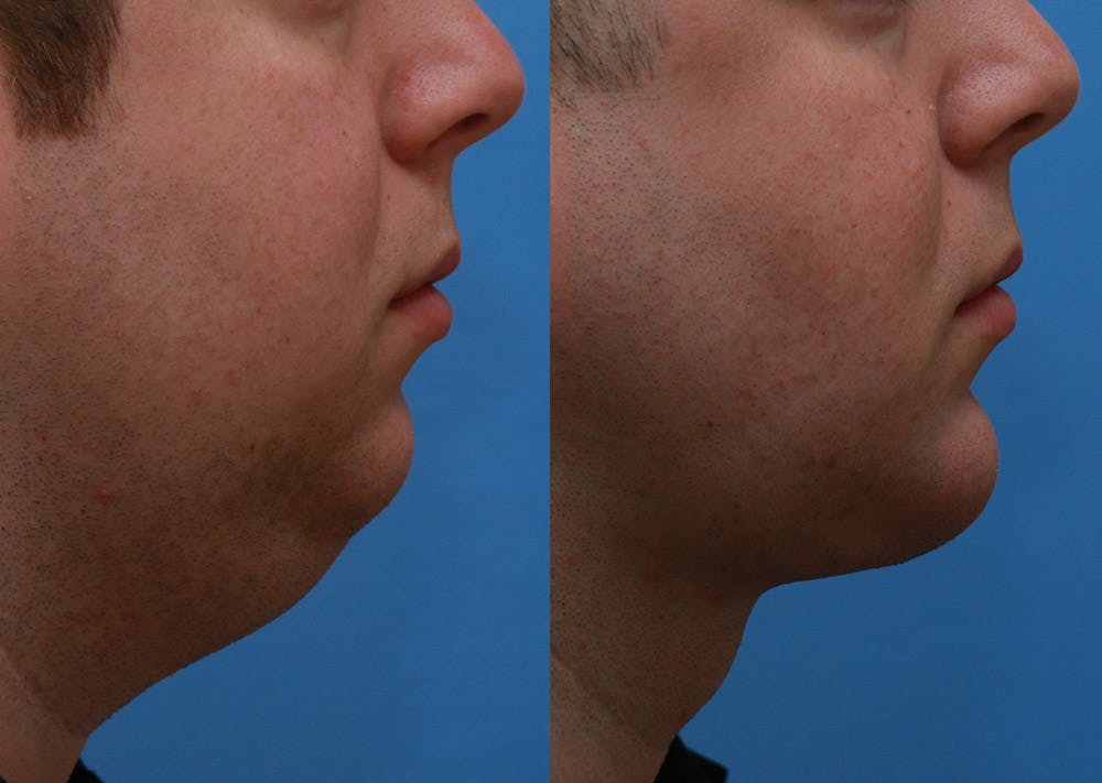 Chin Implants Before & After Gallery - Patient 175971 - Image 1