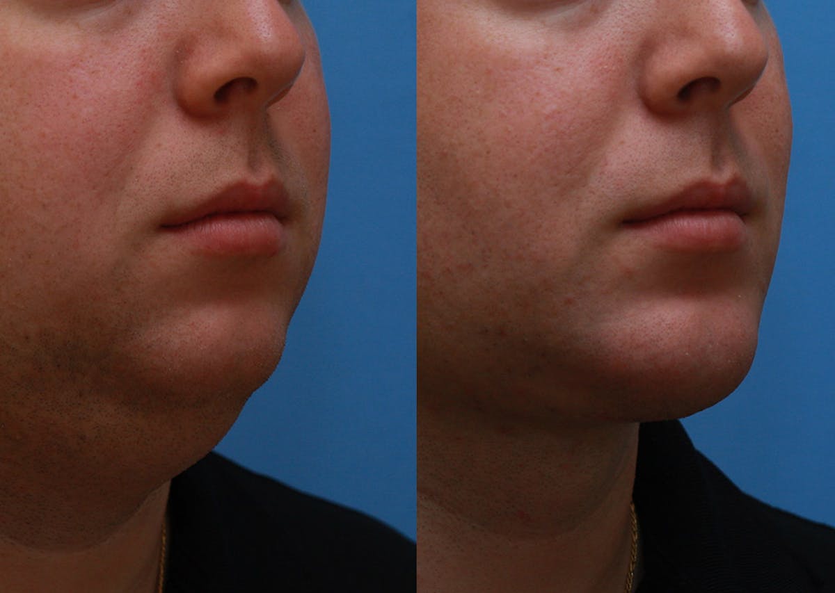 Chin Implants Before & After Gallery - Patient 175971 - Image 2