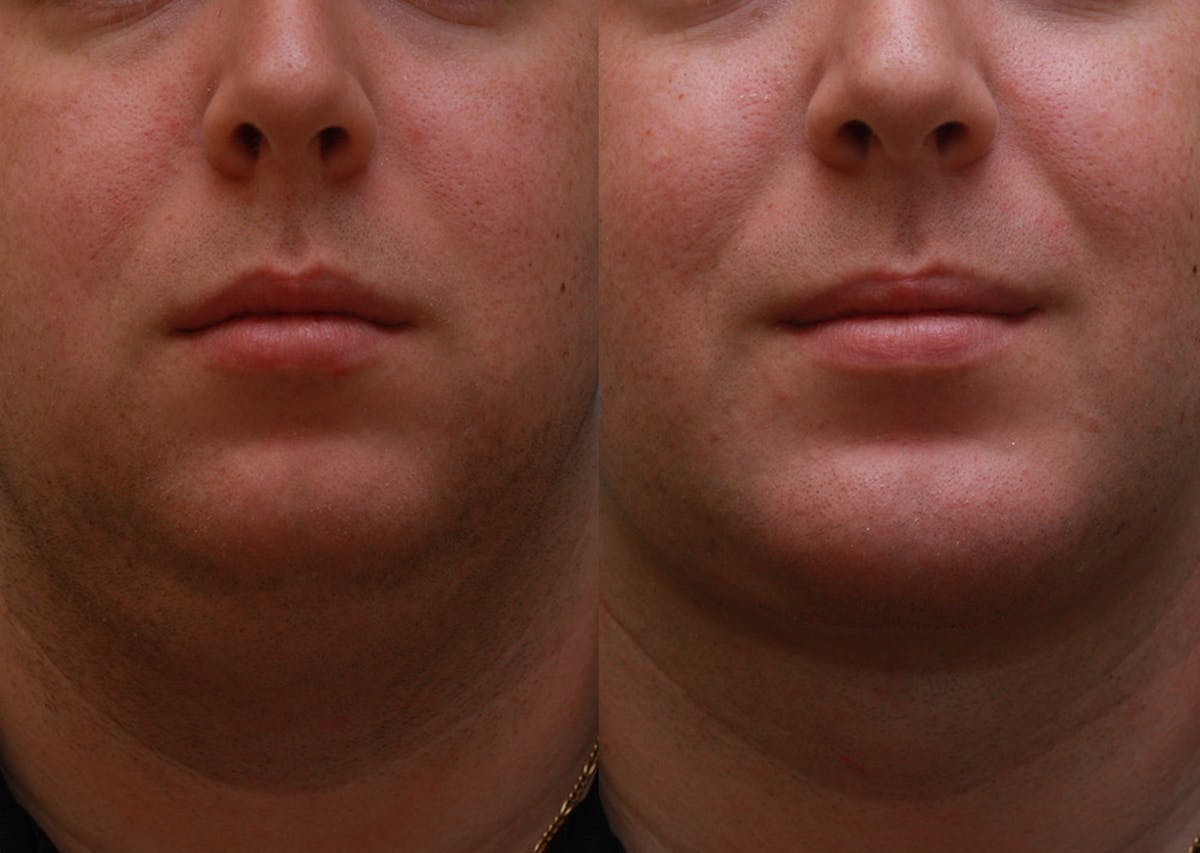 Chin Implants Before & After Gallery - Patient 175971 - Image 3