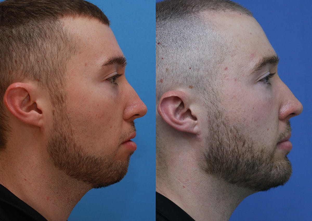 Chin Implants Before & After Gallery - Patient 159549 - Image 1