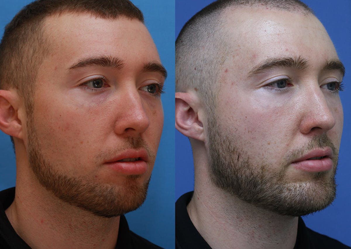 Chin Implants Before & After Gallery - Patient 159549 - Image 2