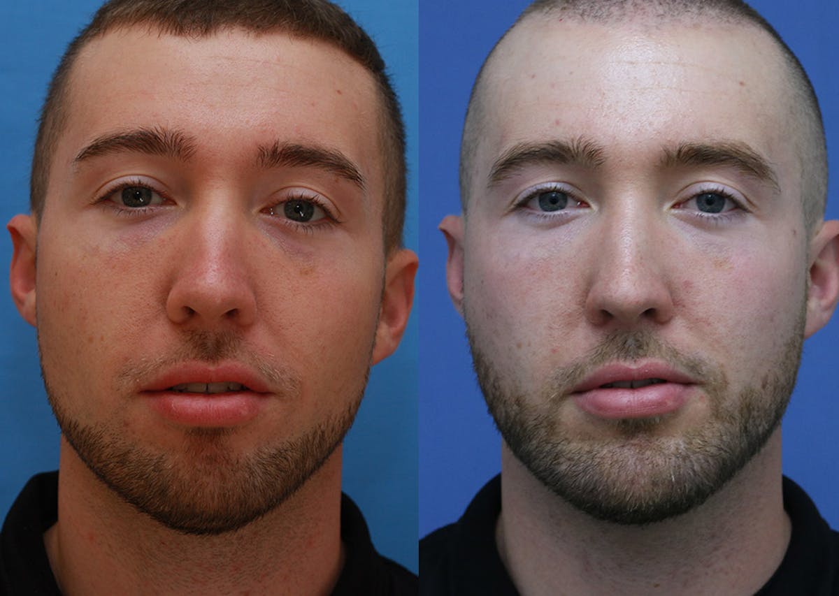 Chin Implants Before & After Gallery - Patient 159549 - Image 3