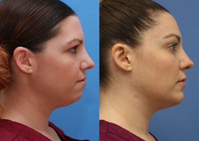 Chin Implants Before & After Gallery - Patient 402835 - Image 1