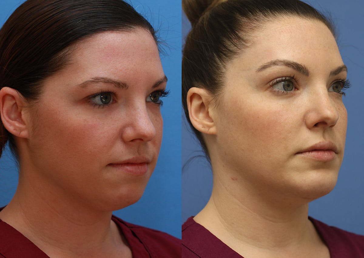 Chin Implants Before & After Gallery - Patient 402835 - Image 2