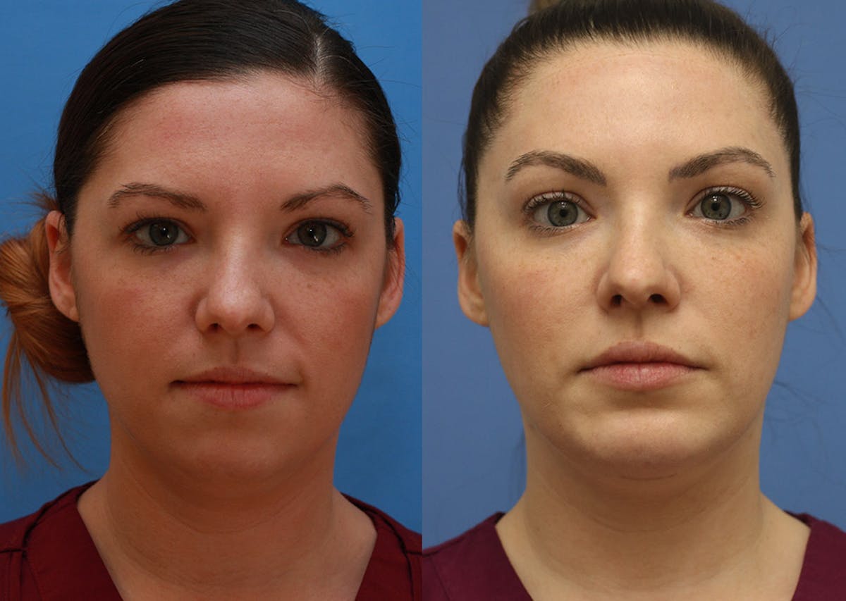 Chin Implants Before & After Gallery - Patient 402835 - Image 3