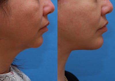 Chin Implants Before & After Gallery - Patient 411844 - Image 1