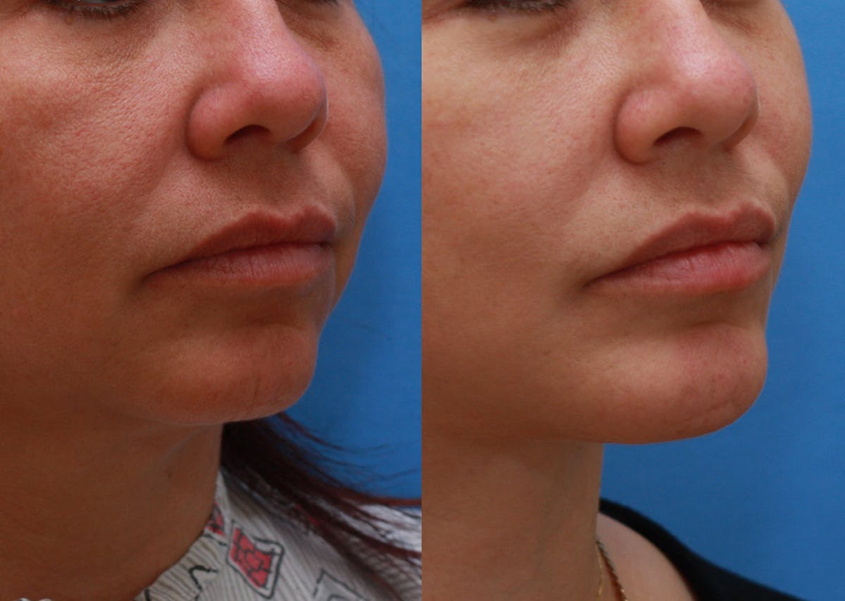 Chin Implants Before & After Gallery - Patient 411844 - Image 2
