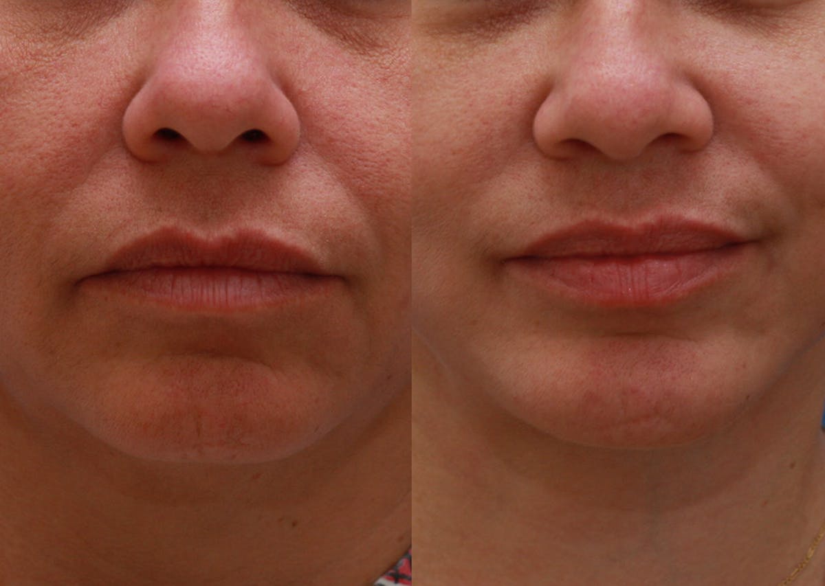 Chin Implants Before & After Gallery - Patient 411844 - Image 3