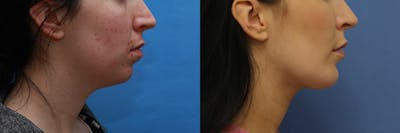 Neck Before & After Gallery - Patient 165522 - Image 1