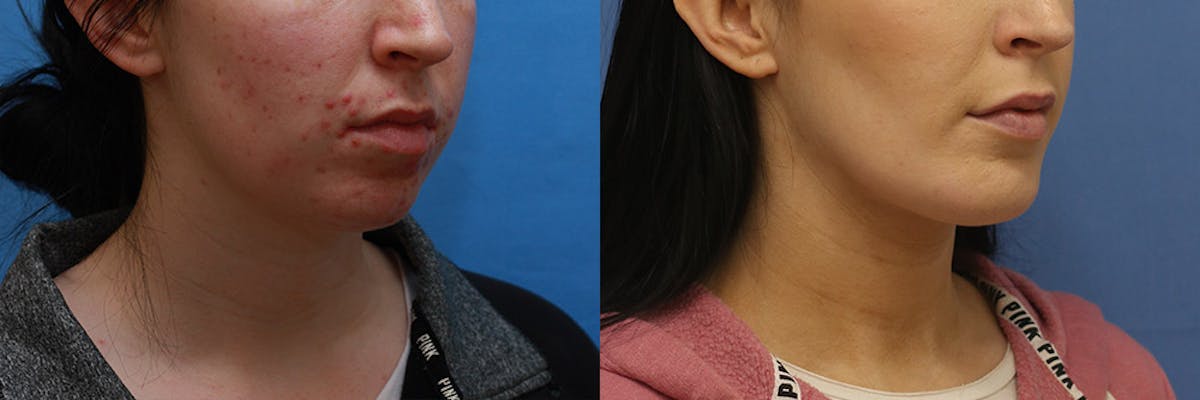 Neck Before & After Gallery - Patient 165522 - Image 2