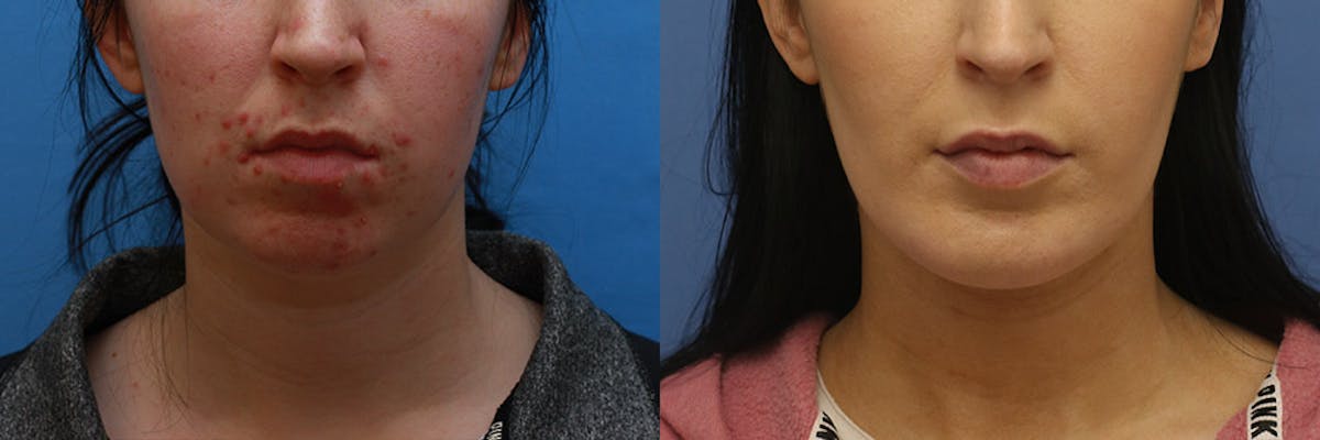 Neck Before & After Gallery - Patient 165522 - Image 3