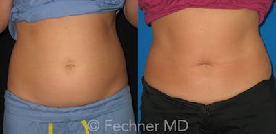 CoolSculpting Before & After Gallery - Patient 371702 - Image 1