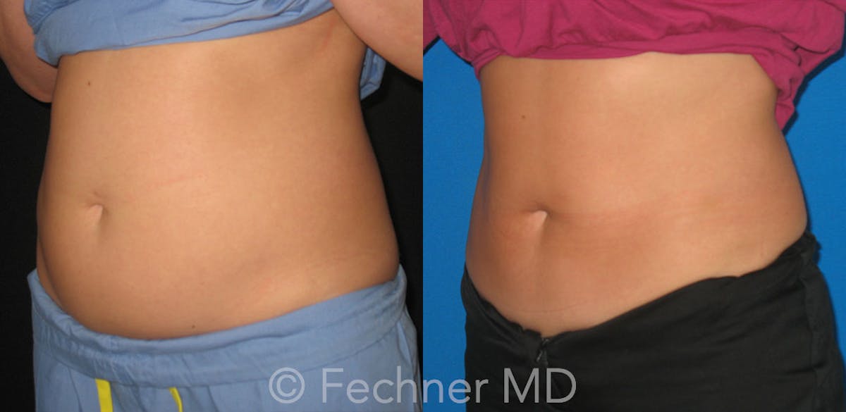 CoolSculpting Before & After Gallery - Patient 371702 - Image 2