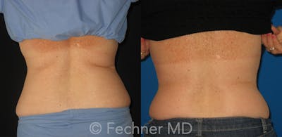 CoolSculpting Before & After Gallery - Patient 136249 - Image 1