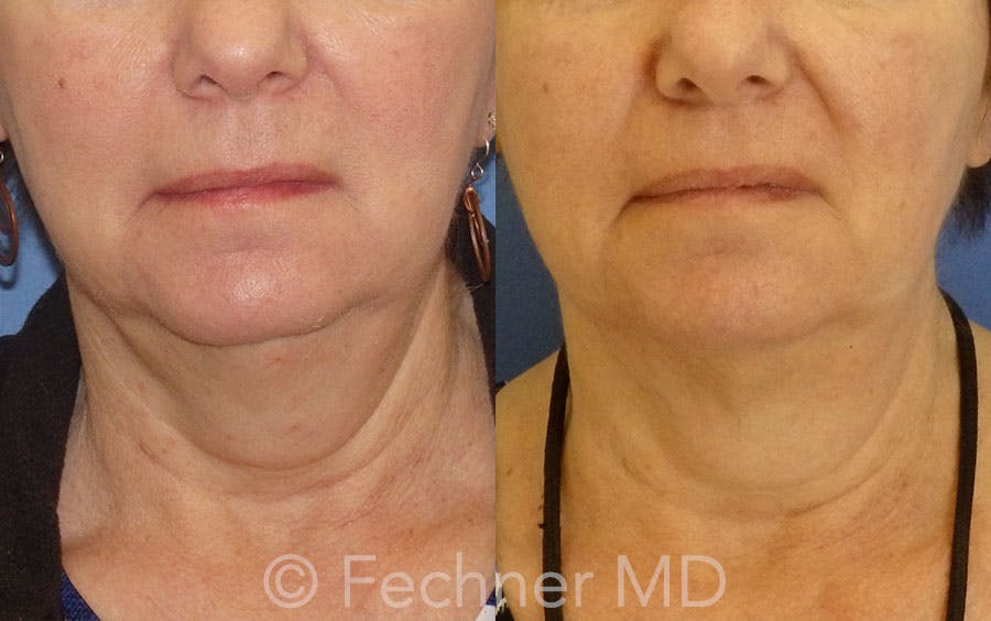 CoolSculpting Before & After Gallery - Patient 106454 - Image 1