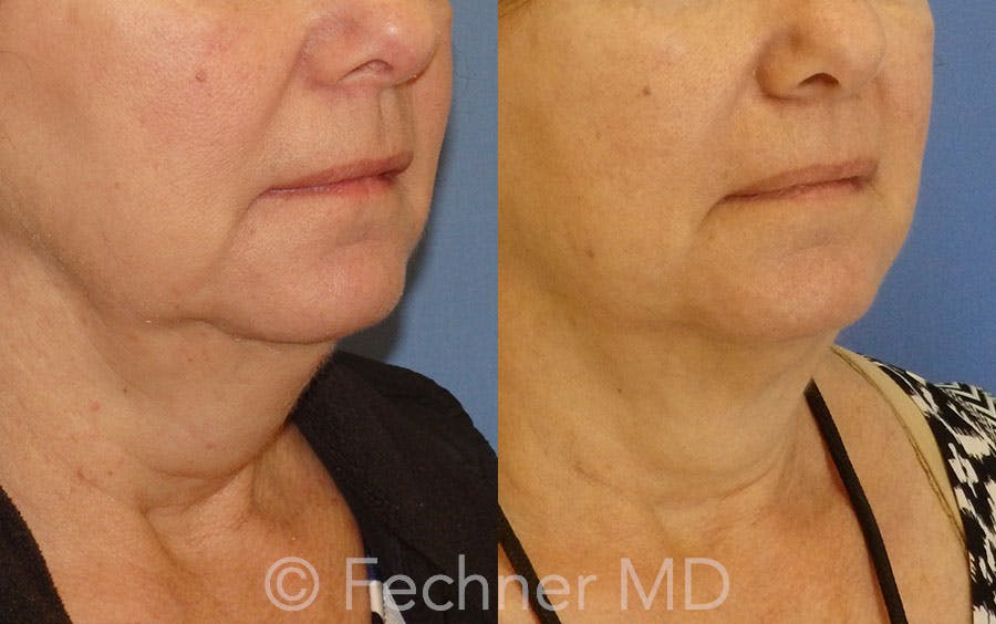 CoolSculpting Before & After Gallery - Patient 106454 - Image 2