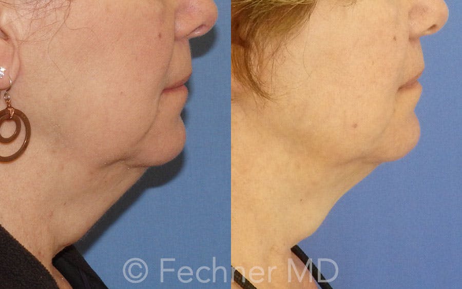CoolSculpting Before & After Gallery - Patient 106454 - Image 3