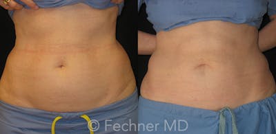 CoolSculpting Before & After Gallery - Patient 386942 - Image 1