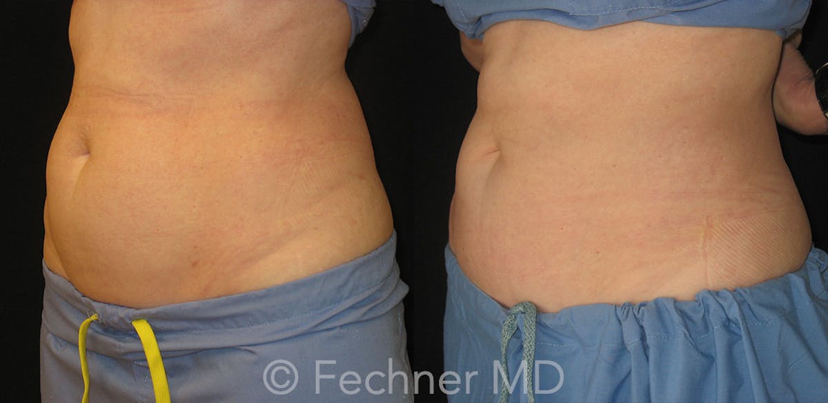 CoolSculpting Before & After Gallery - Patient 386942 - Image 2