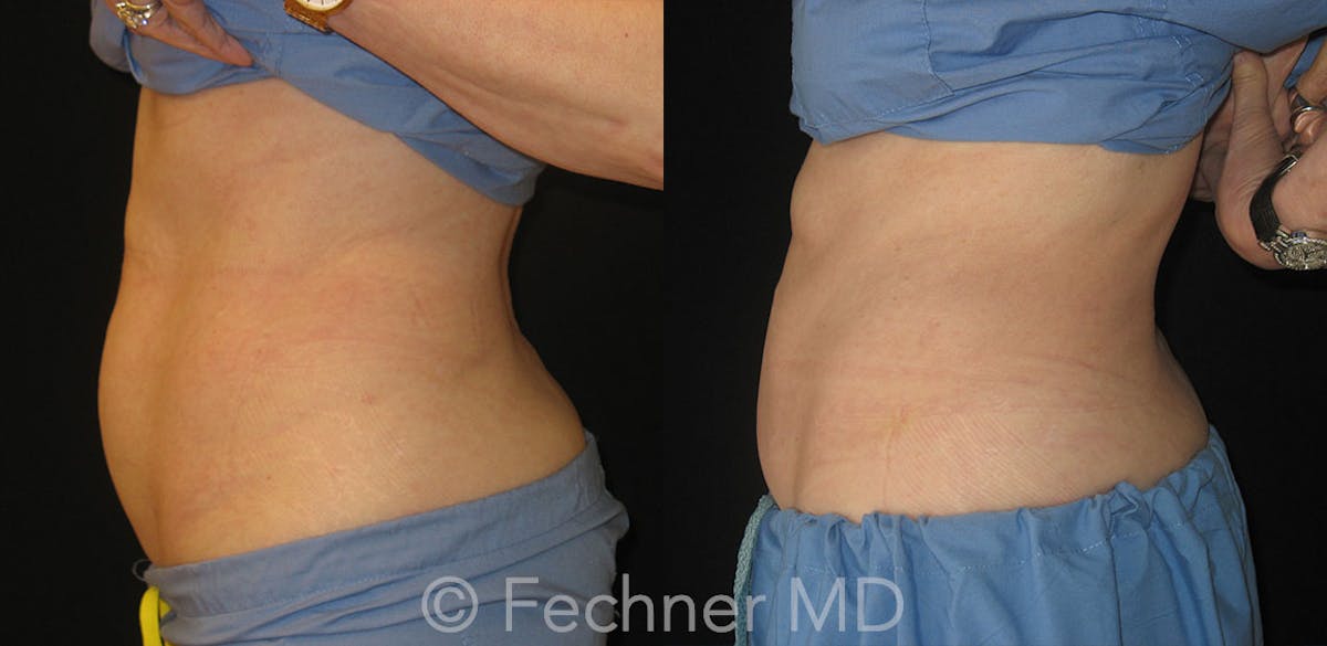 CoolSculpting Before & After Gallery - Patient 386942 - Image 3