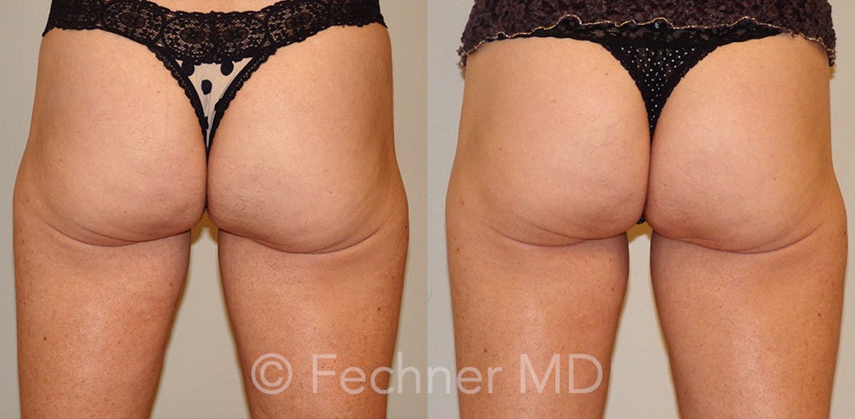 EmSculpt Before & After Gallery - Patient 148756 - Image 1