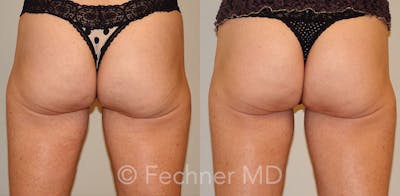 EmSculpt Before & After Gallery - Patient 148756 - Image 1