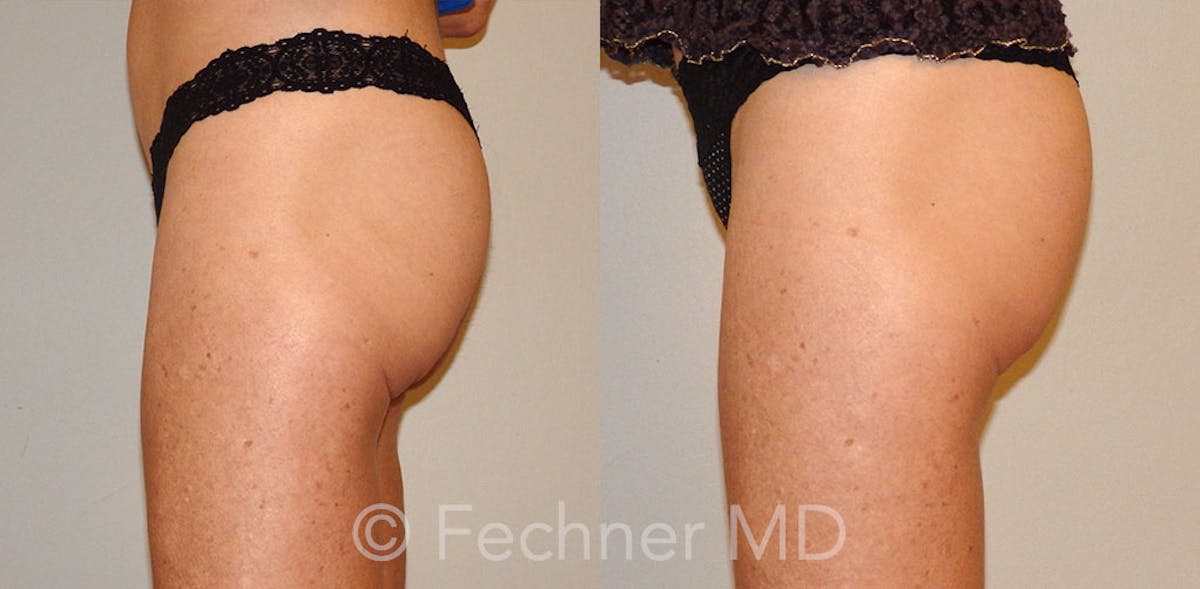 EmSculpt Before & After Gallery - Patient 148756 - Image 2