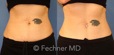 EmSculpt Before & After Gallery - Patient 120336 - Image 1