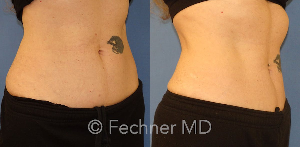 EmSculpt Before & After Gallery - Patient 120336 - Image 2
