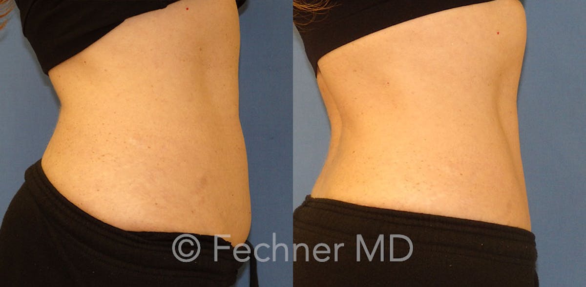 EmSculpt Before & After Gallery - Patient 120336 - Image 3