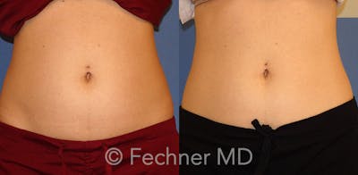 EmSculpt Before & After Gallery - Patient 146659 - Image 1