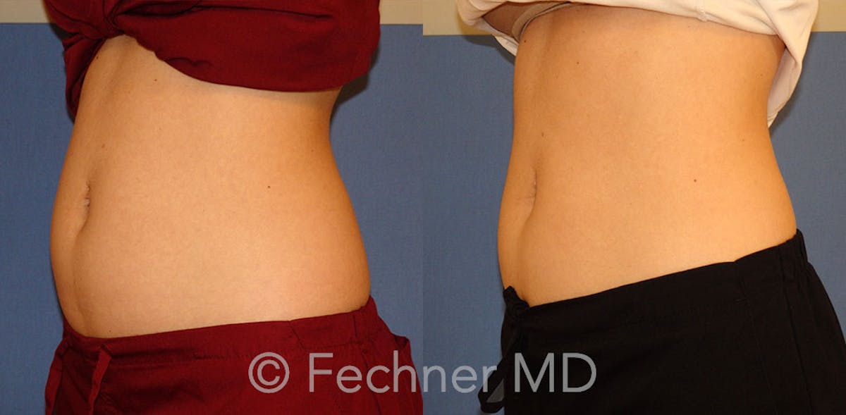 EmSculpt Before & After Gallery - Patient 146659 - Image 2