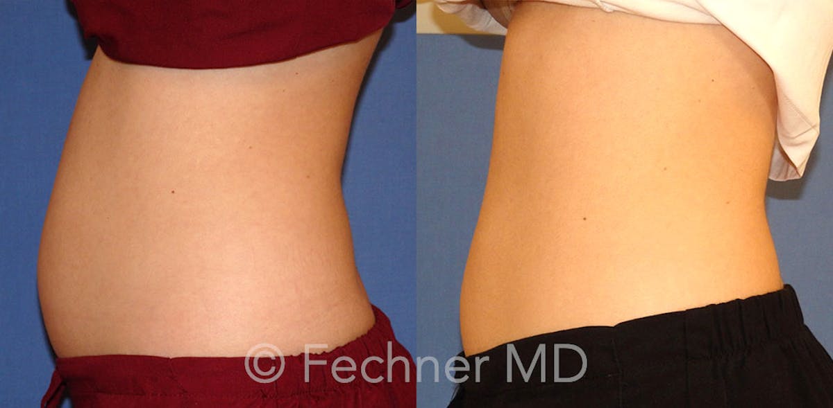 EmSculpt Before & After Gallery - Patient 146659 - Image 3