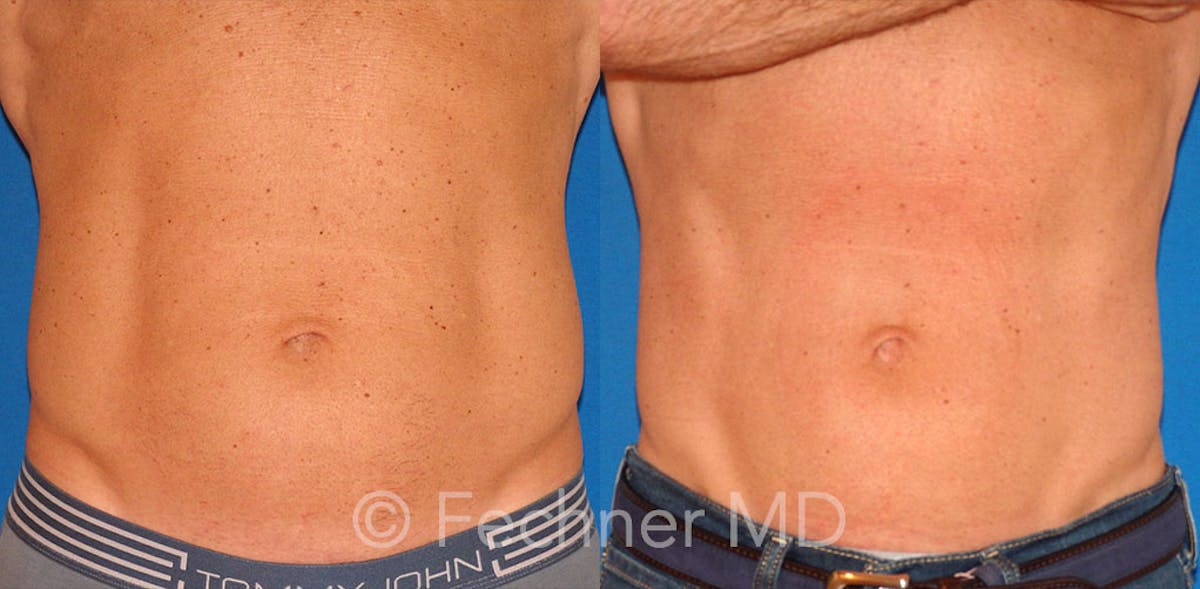 EmSculpt Before & After Gallery - Patient 318793 - Image 1