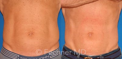 EmSculpt Before & After Gallery - Patient 318793 - Image 1