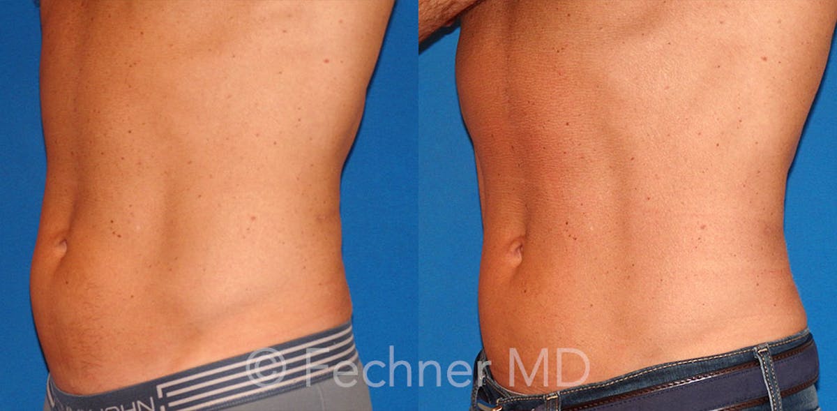 EmSculpt Before & After Gallery - Patient 318793 - Image 2