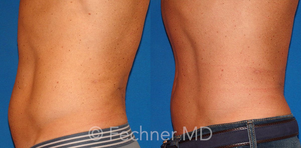 EmSculpt Before & After Gallery - Patient 318793 - Image 3