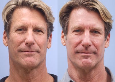 Skin Rejuvenation Before & After Gallery - Patient 323724 - Image 1