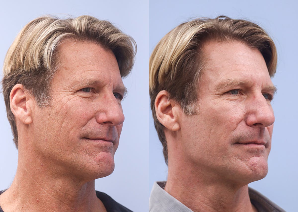 Skin Rejuvenation Before & After Gallery - Patient 323724 - Image 2