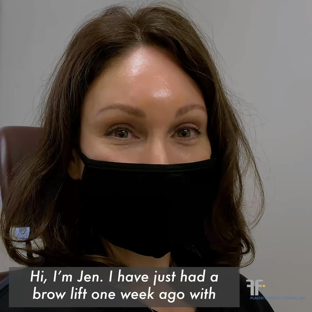 patient of brow lift