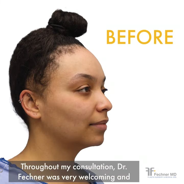 forehead reduction video screenshot