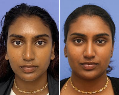 Otoplasty Before & After Gallery - Patient 183224 - Image 1