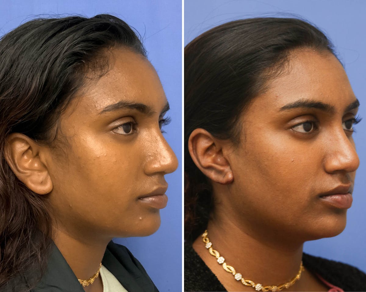 Otoplasty Before & After Gallery - Patient 183224 - Image 2